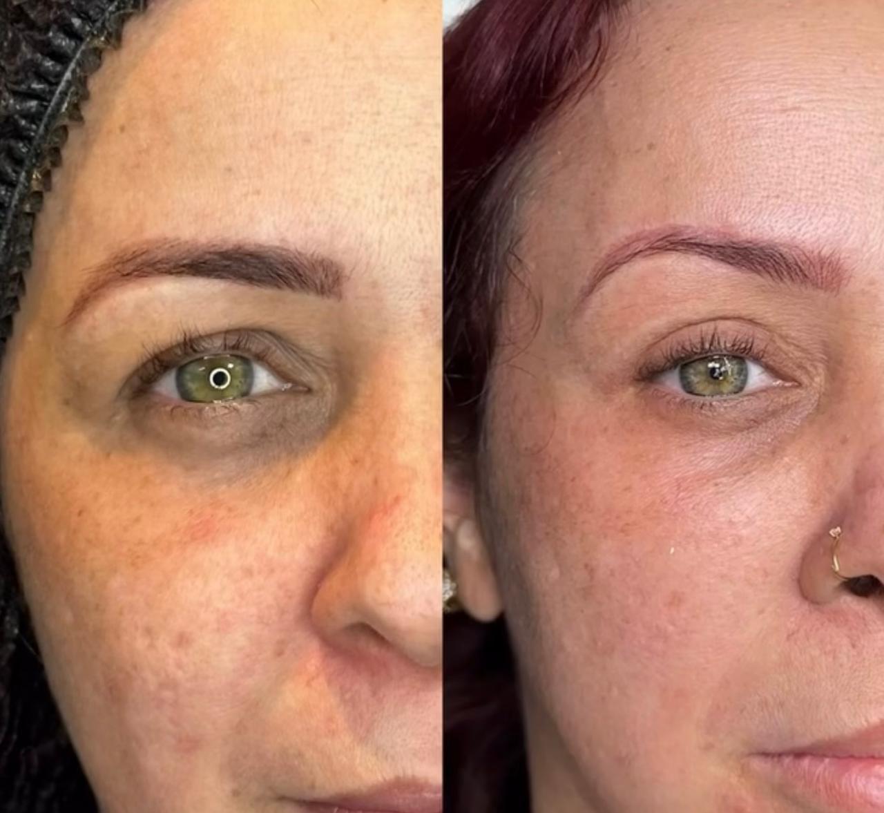 blefaroplastia (2)